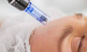 Microneedling - 1 session